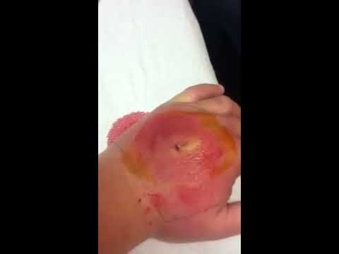 how to drain skin infection