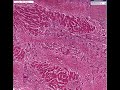Histopathology Liver--Viral hepatitis with fulminant necrosi