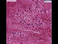 Histopathology Liver--Viral hepatitis with fulminant necrosi