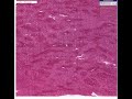 Histopathology Liver--Viral hepatitis with fulminant necrosi