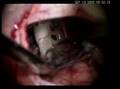 Microvascular Decompression (MVD)