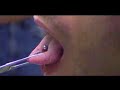PLEASE READ:I bleed like a stuck pig after getting pierced because I drank like an alchi the nite before.