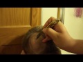 knife to cyst in head