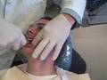 Braces off - removing Sean's braces at Braces by Bergh in Glendale, CA by Dr. Brian H. Bergh, DDS, MS