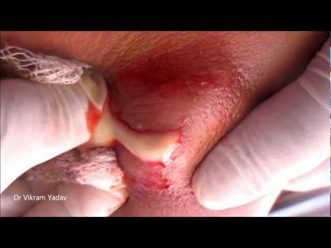 how to drain finger abscess