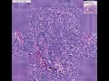 Histopathology Ovary--Serous cystadenocarcinoma