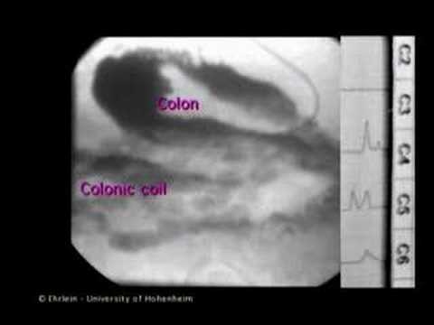 Lower GI Movies - Peristalsis in ...
