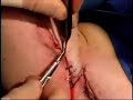 Iowa City Plastic Surgery Live: Arm Lift 6 of 14 Iowa City Plastic Surgery Live: Arm Lift 6 of 14