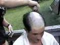 Balding