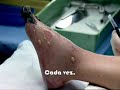 Amputación por fumar