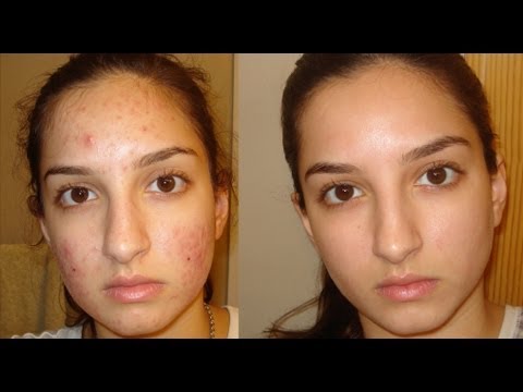 how to get rid of acne on forehead