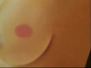 Mammosite: Radiation from the Inside Out