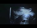 Our little miracle: Ultrasound at 5 weeks 3 days gestation