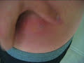 gross puss popped pimple boil nasty infection mrsa zit fluid disgusting staph