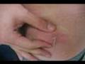 draining abscess