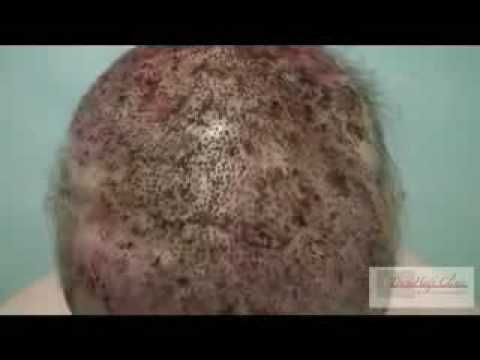 how to do hair transplant yourself