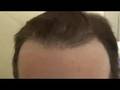 Dr Ray Woods: Body Hair Transplant