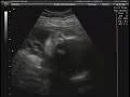 Ecograf�a 29 semanas (casi 3D - primer intento)