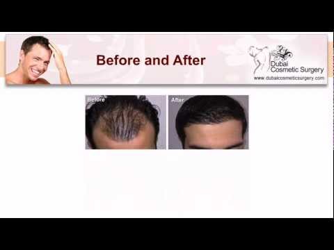 how to know when to transplant