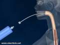 Balonul intragastric - introducerea