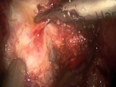 how to repair uterine rupture