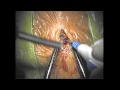 Subdural Chronic Hematoma