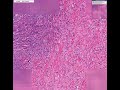 Histopathology Ovary--Theca cell tumor