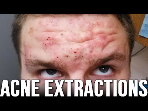 Acne Extractions | Retin-A & Accutane (Week 67)