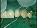 Ceram X duo Diastema Dr. B.Klaiber /1