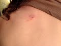 Cyst: Dad\