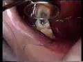 Ortodoncia - Stripping posterior