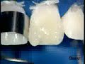CeramX duo restauraci�n Clase IV Dr P.Colon /2