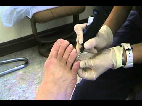 how to treat onychomycosis