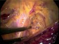 Tratamiento laparosc�pico del compartimiento anterior