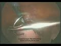 Laparoscopic Myomectomy