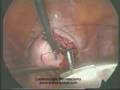Laparoscopic Myomectomy