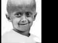Progeria Infantiles