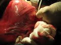 multiple fibroids 2
