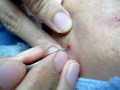 Japanese acne treatment