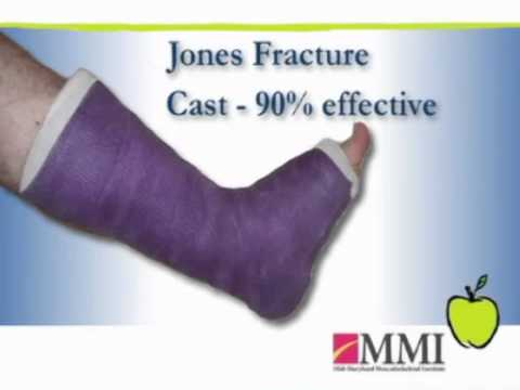 how to treat jones fracture