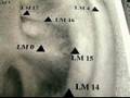 Treating Common Ailments With Acupuncture : Addiction Treatment With Acupuncture