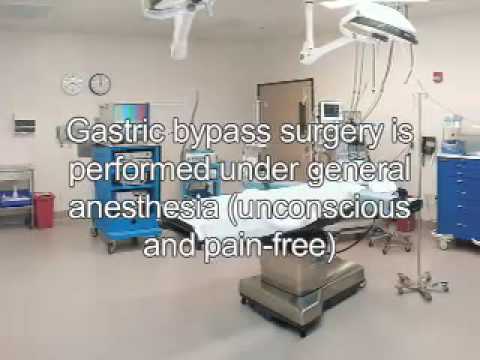 Open Gastric Bypass for Obesity by ...