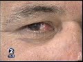 Pterygium Surgery Update Using Radiofrequency