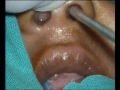 Septal_abscess1.flv