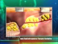 THE Doctotrs Features Reaction by Viora for Cellulite Treatments