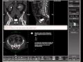 Tips &amp; Tricks Video: Creating a Curved View of the Ureter
