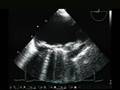 videos de TEE Rt side Aortic Arch