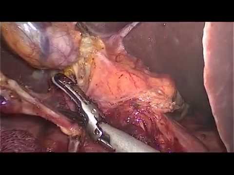 how to get rid of diarrhea nhs