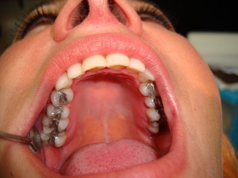 dental fetish - Supermodel at the Dentist getting her cavities filled with amalgam, full treatment video, dental clinical case GET the complete footage in HQ on http://www.b...