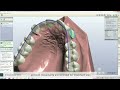 3Shape OrthoAnalyzer 2010 Preview